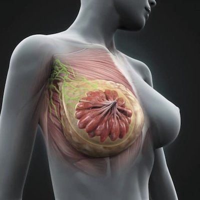 Καρκίνος του μαστού Breast cancer ΕΦΗ ΡΟΜΠΟΤΗ - EFI ROBOTI ΜΑΙΕΥΤΗΡΑΣ-ΧΕΙΡΟΥΡΓΟΣ ΓΥΝΑΙΚΟΛΟΓΟΣ GYNAECOLOGIST – OBSTETRICIAN