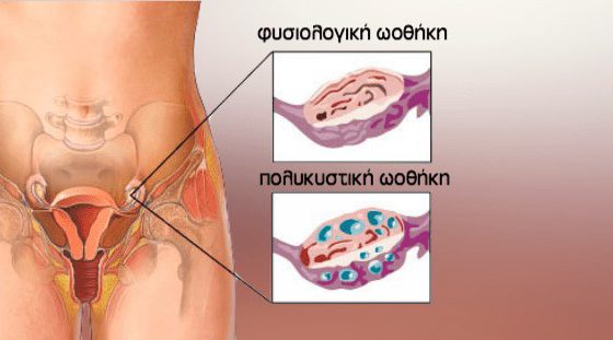 Polycystic ovaries πολυκυστικές ωοθήκες