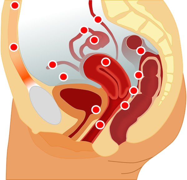 Ενδομητρίωση endometriosis ΕΦΗ ΡΟΜΠΟΤΗ - EFI ROBOTI ΜΑΙΕΥΤΗΡΑΣ-ΧΕΙΡΟΥΡΓΟΣ ΓΥΝΑΙΚΟΛΟΓΟΣ GYNAECOLOGIST – OBSTETRICIAN